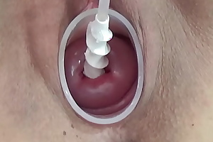 Milf cervix insertion with spiral catheter for insemination and vibrator jav extreme